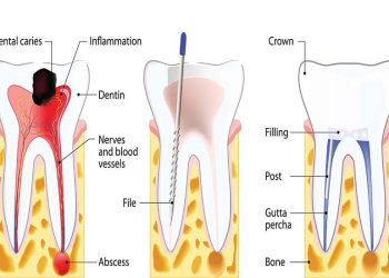 Root Canal Treatment