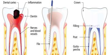 Root Canal Treatment