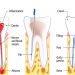 Root Canal Treatment