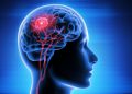 Brain Tumor