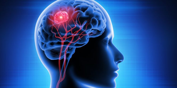 Brain Tumor