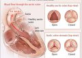 Options for the Treatment of Aortic Stenosis