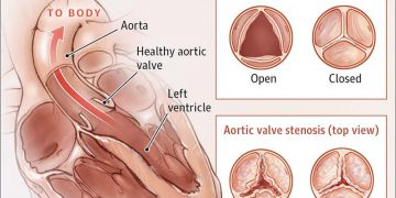 Options for the Treatment of Aortic Stenosis