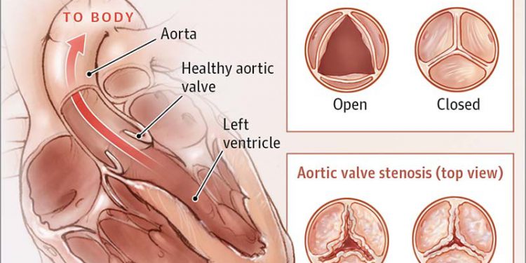 Options for the Treatment of Aortic Stenosis