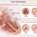 Options for the Treatment of Aortic Stenosis