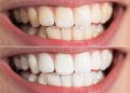 Is it Possible to Whiten your Teeth With Hydrogen Peroxide?