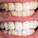 Is it Possible to Whiten your Teeth With Hydrogen Peroxide?