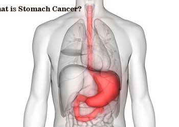 What is Stomach Cancer