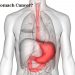 What is Stomach Cancer
