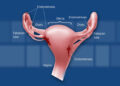 Endometriosis