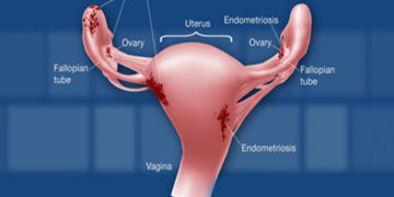 Endometriosis