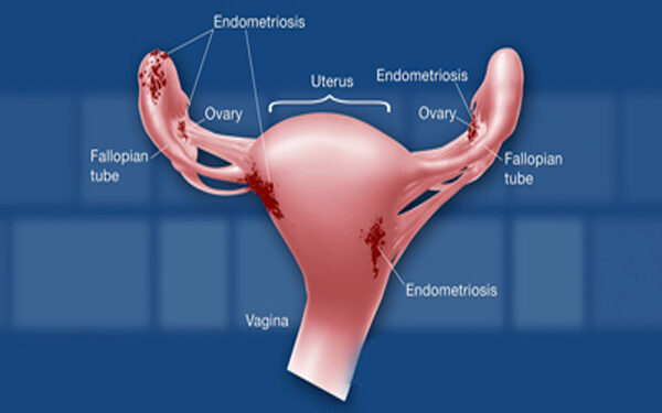 Endometriosis