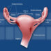 Endometriosis